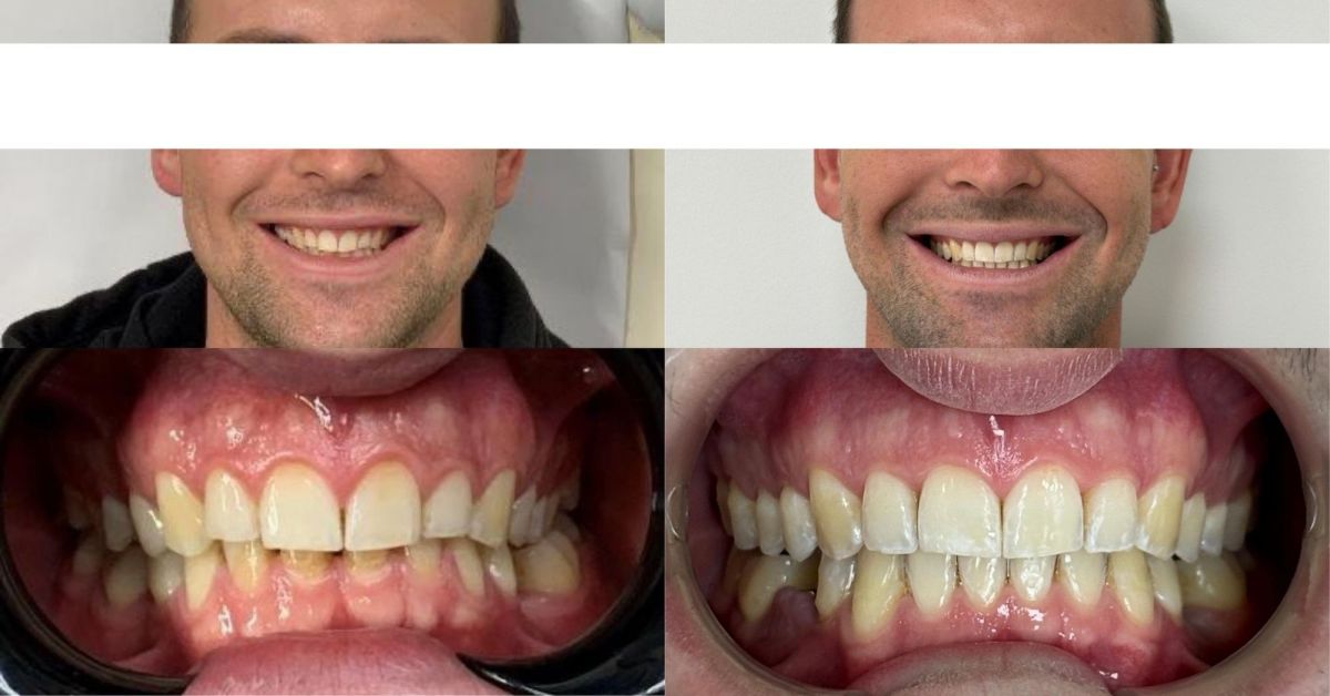 Quanto è importante l'utilizzo degli elastici in ortodonzia?